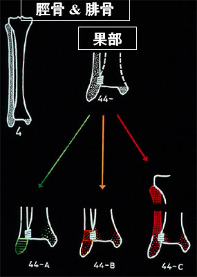 図1．足関節骨折のAO分類