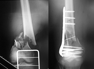図3．若年者の骨折時X線写真とプレート固定による手術後X線写真