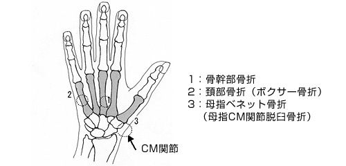 図2.中手骨骨折のいろいろ　1：骨幹部骨折、2：頚部骨折（ボクサー骨折）、3：母指ベネット骨折（母指CM関節脱臼骨折）※矢印はCM関節