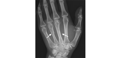 図3.第3および第4中手骨骨幹部骨折（矢印）