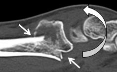図3-1　コレス骨折のCT像