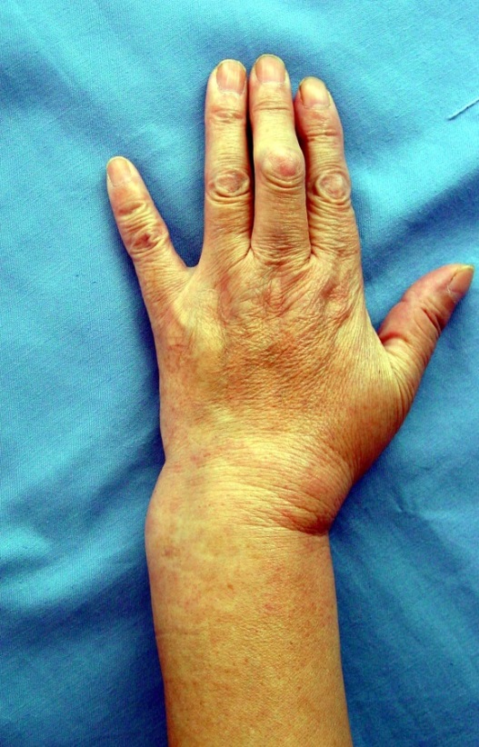 図8　変形治癒した手の外観