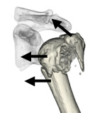 図2　骨折の転位