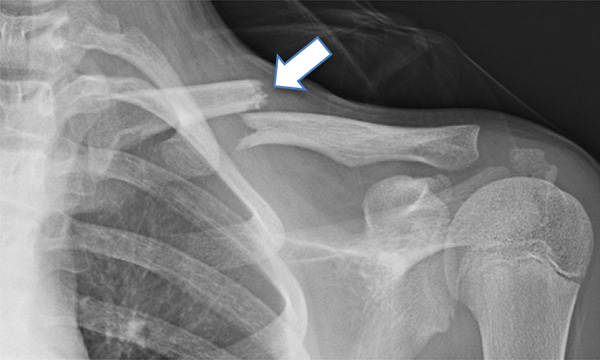 鎖骨骨折 一般社団法人 日本骨折治療学会