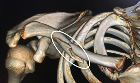鎖骨骨折 一般社団法人 日本骨折治療学会
