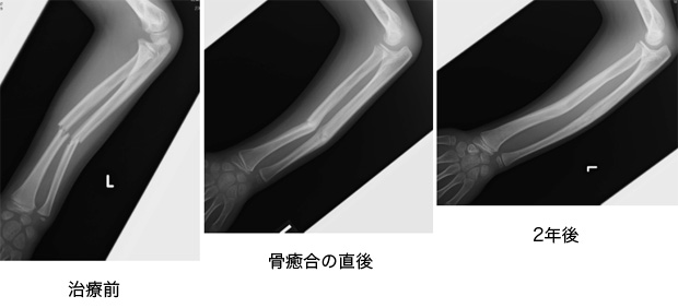 前腕の骨幹部骨折 一般社団法人 日本骨折治療学会 骨折の解説