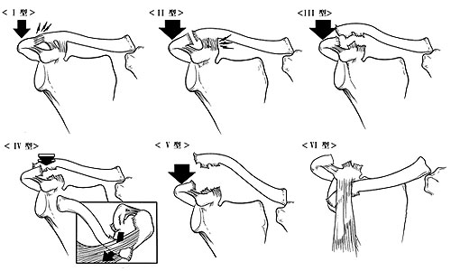 図2.肩鎖関節損傷の分類