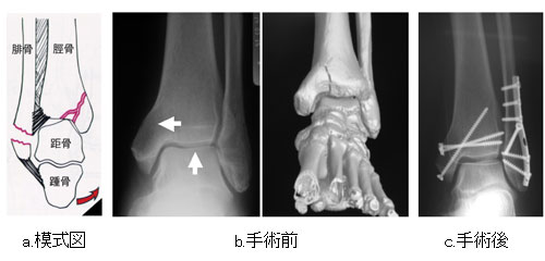 図2．タイプA骨折