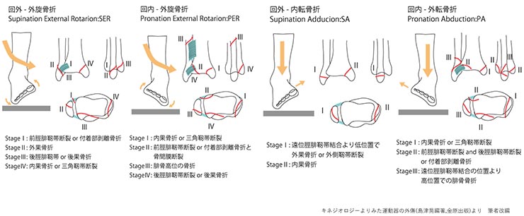 足首骨折損傷の種類