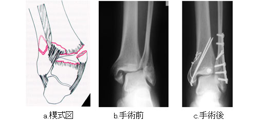 足関節骨折 一般社団法人 日本骨折治療学会 骨折の解説