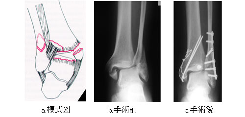 図3．タイプB骨折