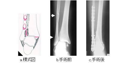 足関節骨折 一般社団法人 日本骨折治療学会 骨折の解説