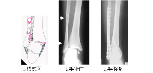 骨折 足首