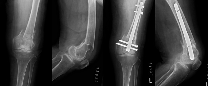 図2．高齢者の骨折時X線写真　髄内釘による手術後X線写真
