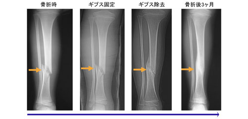 図1.小児の骨折の自家矯正