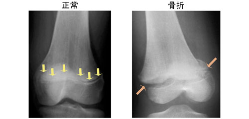 図2.小児の大腿骨遠位部（膝の部分）のレントゲン像