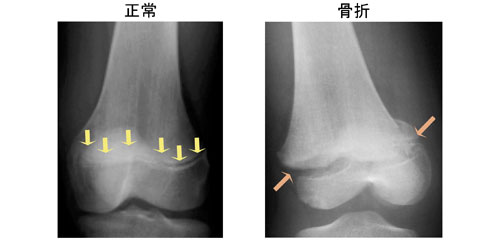 こどもが骨折してしまった ひょっとして骨折 一般社団法人 日本骨折治療学会 骨折の解説