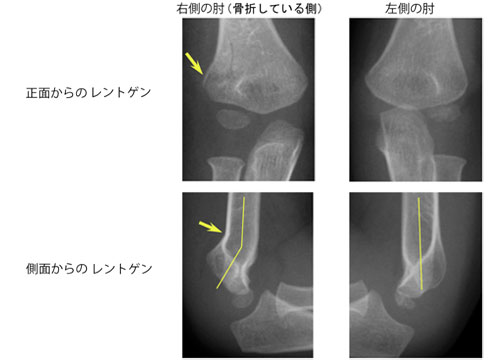 こどもが骨折してしまった ひょっとして骨折 一般社団法人 日本骨折治療学会 骨折の解説