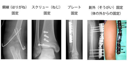 図5.手術による様々な固定法