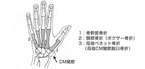 手の中手骨骨折 一般社団法人 日本骨折治療学会 骨折の解説