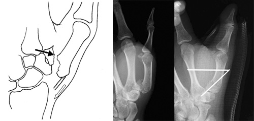 手の中手骨骨折 一般社団法人 日本骨折治療学会 骨折の解説