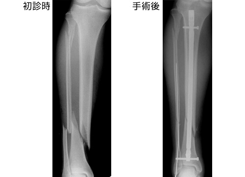 下腿の骨幹部骨折 一般社団法人 日本骨折治療学会 骨折の解説
