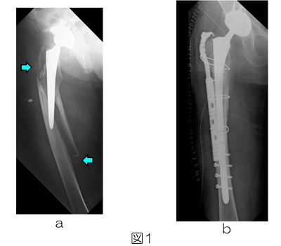 図1　70歳代女性：人工股関節置換術後の人工関節周囲骨折、人工関節のかなりの部分に骨折が及んだことによるゆるみあり