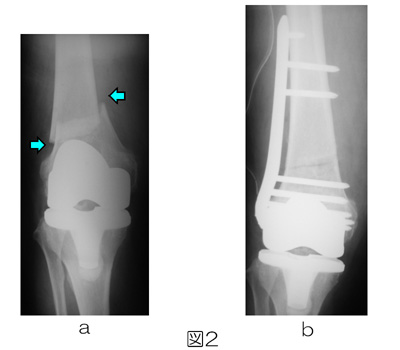 図2　70歳代女性：人工膝関節置換術後の人工関節周囲骨折、ゆるみなし