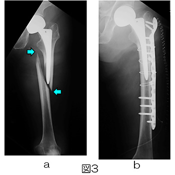 図3　80歳代男性：人工骨頭置換術後の人工関節周囲骨折、ゆるみなし