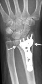 橈骨遠位端骨折 一般社団法人 日本骨折治療学会 骨折の解説