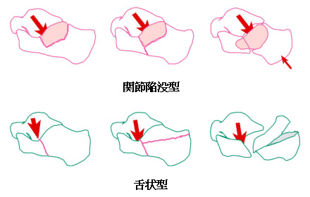 図2. 術前はこうなっている