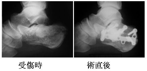 踵 骨 骨折 リハビリ