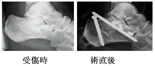 踵骨骨折に対する小侵襲内固定術