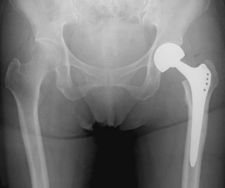 写真4　左大腿骨頚部骨折に対する人工骨頭置換術