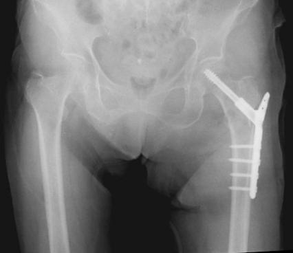 写真5　左大腿骨転子部骨折に対する骨接合術①