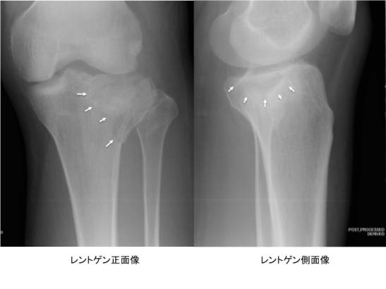 脛骨プラトー骨折 一般社団法人 日本骨折治療学会 骨折の解説