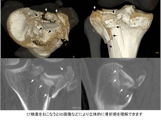 高原 骨折 脛骨 左