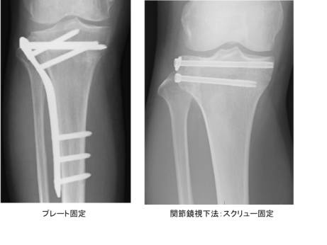 脛骨プラトー骨折 一般社団法人 日本骨折治療学会 骨折の解説