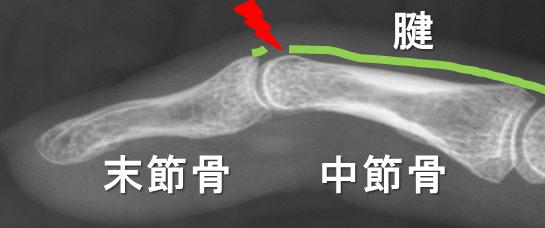 突き指 たかが突き指 されど突き指 一般社団法人 日本骨折治療学会 骨折の解説