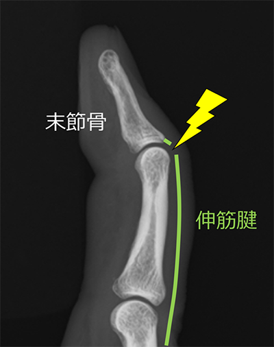 図1.伸筋腱が切れてしまった状態「腱性槌指」といいます