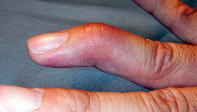 骨折 突き指 違い と の 指の骨折の症状！突き指との違い／見分ける方法は？