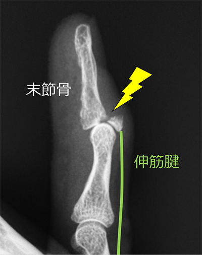 図2.末節骨が折れてしまった状態「骨性槌指」といいます