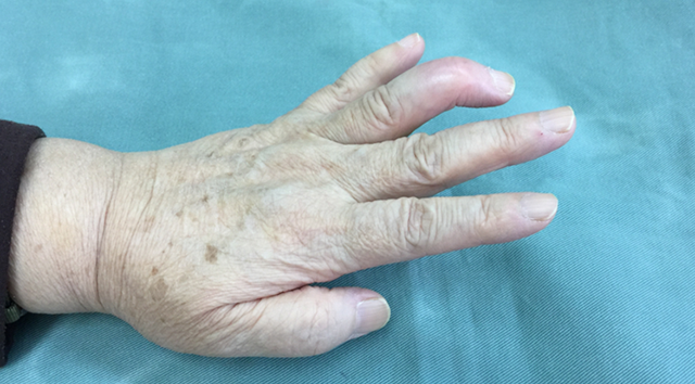 図3.くすり指の槌指（腱性槌指）