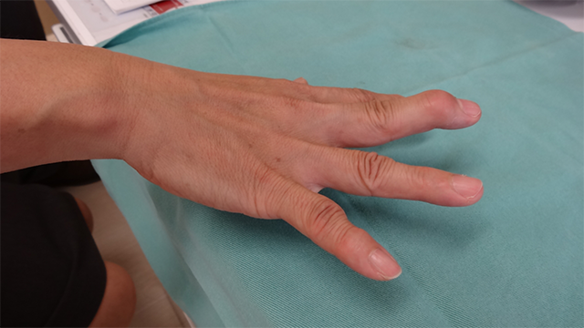 図4.中指の槌指を治療しなかったため、「白鳥の首変形」と呼ばれる指の変形を生じてしまいました