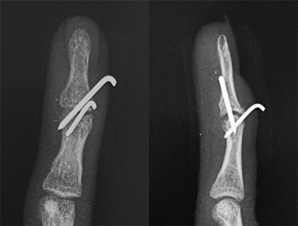 図9.熱可塑性素材を用いた装具