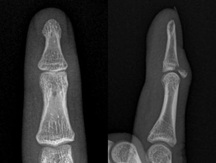 図10.右ひとさし指の骨性槌指
