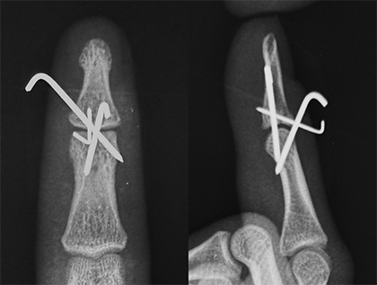 図11.３本の金属ピンで治療を行いました