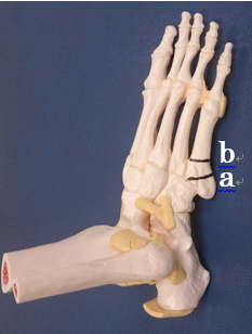 第5中足骨骨折 いわゆる下駄履き骨折と疲労骨折 一般社団法人 日本骨折治療学会 骨折の解説