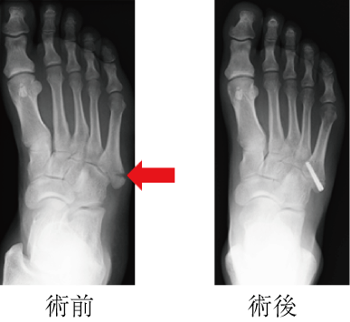 指 の 骨 ひび 症状