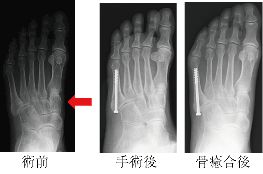 足 指 付け根 骨折